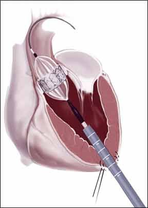 Understand the Risks, Realities Of Having a Bioprosthetic Valve - Heart ...