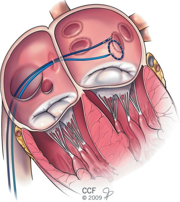 Ablation During Mitral Valve Surgery May Reduce Afib - Heart Advisor