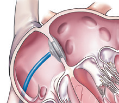 Closing a Hole in Your Heart - Heart Advisor