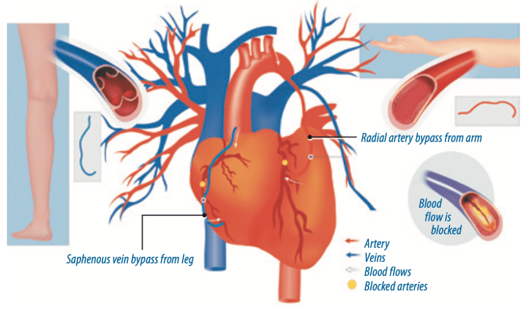 CABG Recommendations Change - Heart Advisor