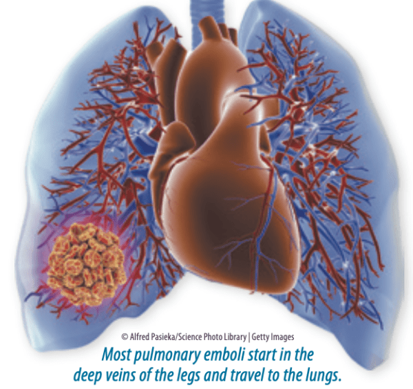 act-swiftly-to-treat-a-blood-clot-in-your-lungs-heart-advisor